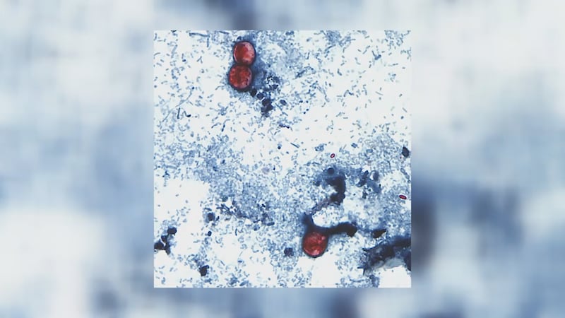 Cyclosporiasis cases increasing in Michigan